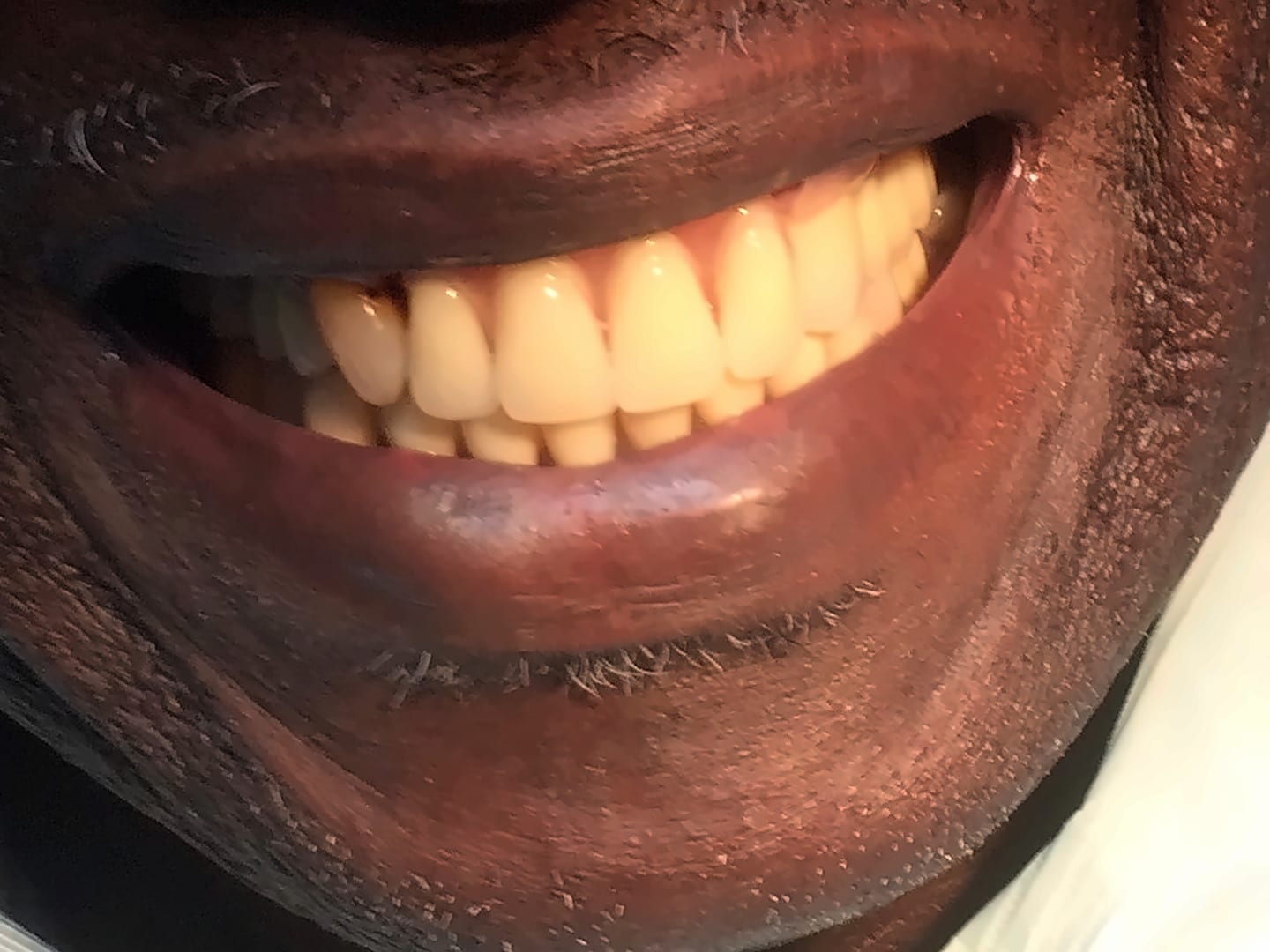 After: a full smile with dentures